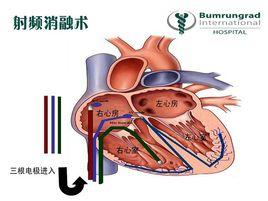 心臟射頻消融術
