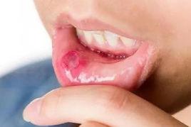 空腔潰瘍 空腔潰瘍