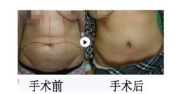 腹部拉皮術 腹部拉皮術