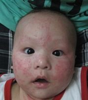 兒童濕疹 兒童濕疹