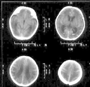 新生兒低鈣血症