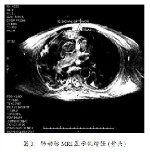 吸氣性呼吸困難 吸氣性呼吸困難