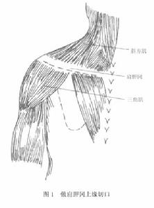 （圖）肩胛上神經卡壓症