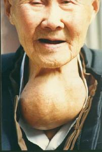 單純性甲狀腺腫