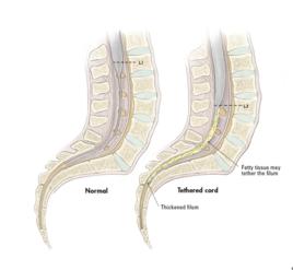 脊髓栓系 脊髓栓系