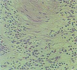 Stevens–Johnson syndrome