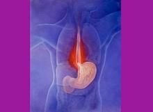 胃食管返流症 胃食管返流症