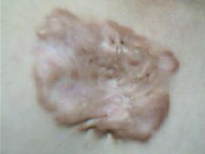 增生性疤痕體質