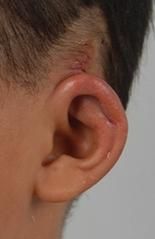 隱耳矯正術