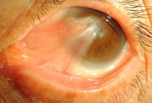 翼狀胬肉 翼狀胬肉