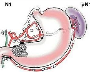 反流性胃炎 反流性胃炎