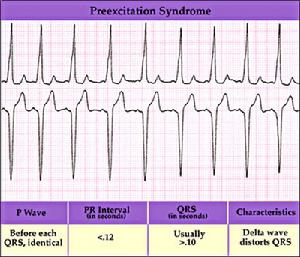 左束支傳導阻滯