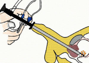 經尿道膀胱腫瘤電切術