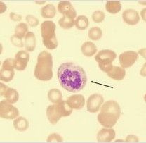 惡性貧血 惡性貧血