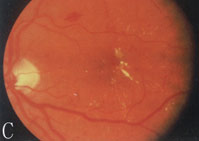 高尿酸血症腎病