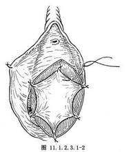 前庭大腺囊腫 前庭大腺囊腫