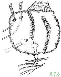 可控性迴腸膀胱術 可控性迴腸膀胱術