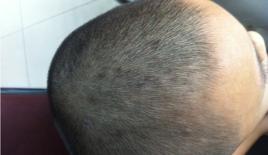 頭部牛皮癬 頭部牛皮癬