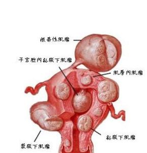子宮腫瘤 子宮腫瘤