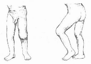 （圖）膝關節結核