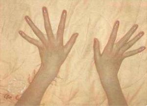 Marfan綜合徵 Marfan綜合徵