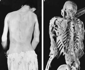 石人綜合徵 石人綜合徵