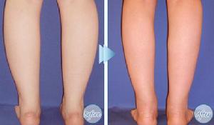 肌肉小腿退縮術 肌肉小腿退縮術