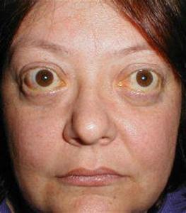 甲狀腺病態綜合症 甲狀腺病態綜合症