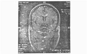 垂體平掃 垂體平掃