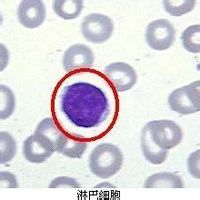 溢出性蛋白尿 溢出性蛋白尿