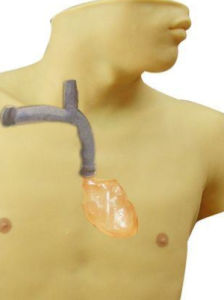 經外周靜脈穿刺中心靜脈置管 經外周靜脈穿刺中心靜脈置管