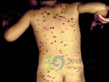 自身免疫性孕酮性皮炎 自身免疫性孕酮性皮炎