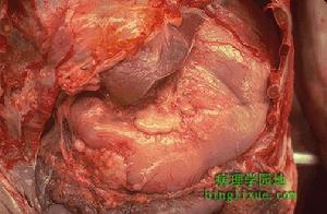 十二指腸胃反流