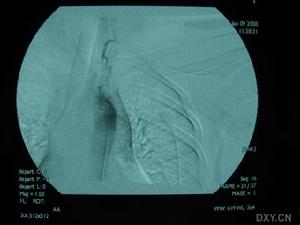 顱內肉芽腫性動脈炎