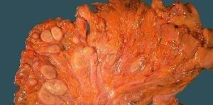 小兒腸系膜淋巴結結核