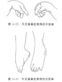 嬰兒手足搐搦症 嬰兒手足搐搦症