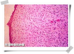 陰道轉移性腫瘤