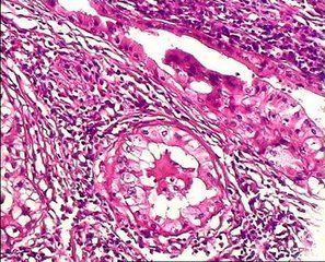 腺泡細胞癌 腺泡細胞癌