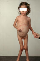 遺傳性高酪胺酸血症 遺傳性高酪胺酸血症