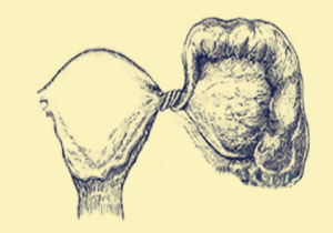 卵巢扭轉 卵巢扭轉