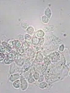 陰道毛滴蟲 陰道毛滴蟲