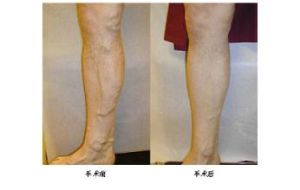 下肢靜脈曲張微創手術 下肢靜脈曲張微創手術