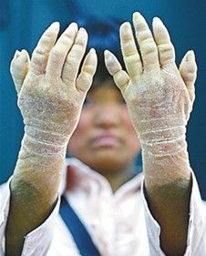 合肥魚鱗病醫院 合肥魚鱗病醫院