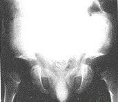 假性軟骨發育不良 假性軟骨發育不良