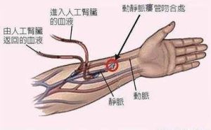 動靜脈穿刺 動靜脈穿刺