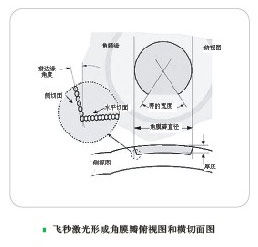 飛秒雷射製作角膜瓣原理