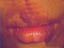 變態反應性口炎 變態反應性口炎