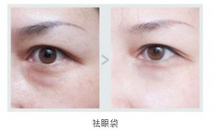 貴陽麗都Bella Vita祛眼袋案例