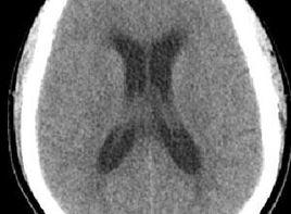 四疊體受壓 四疊體受壓
