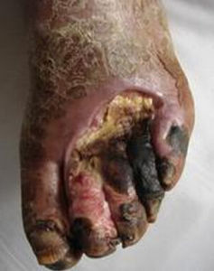 糖尿病足 糖尿病足